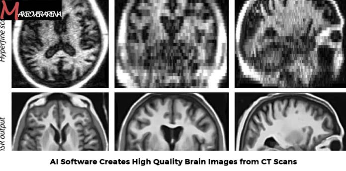 AI Software Creates High Quality Brain Images from CT Scans