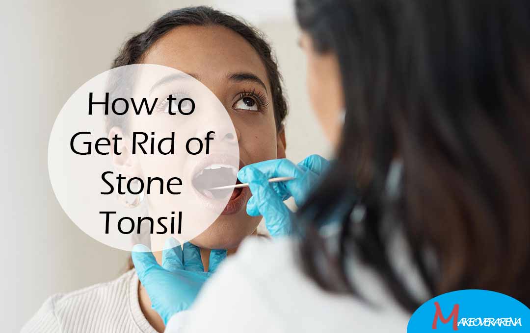 How to Get Rid of Stone Tonsil
