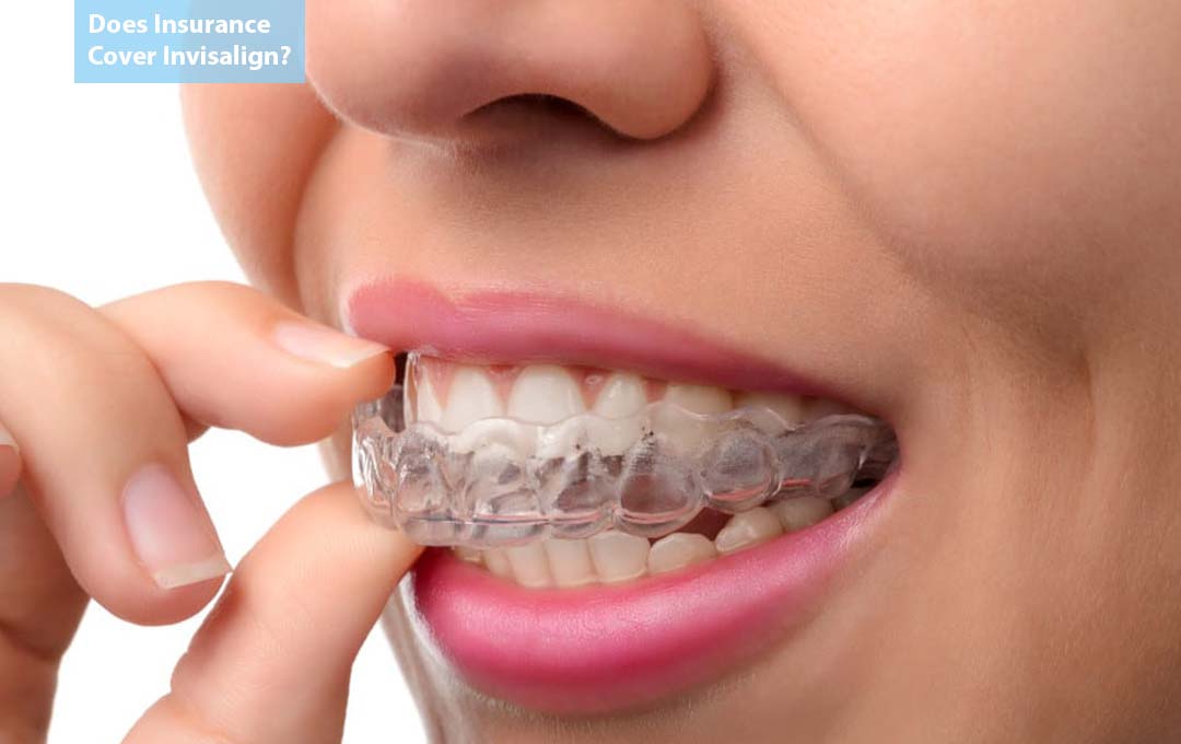 Does Insurance Cover Invisalign? 